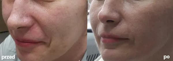 Kiedy można myć twarz po laserze frakcyjnym – uniknij powikłań