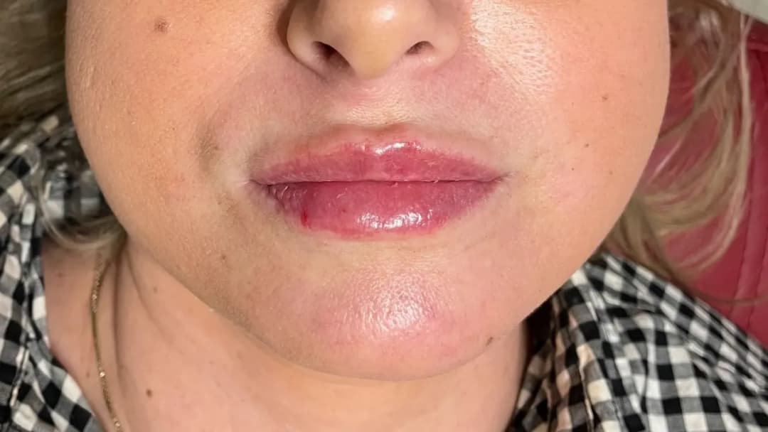 Jak spać po kwasie hialuronowym, by uniknąć komplikacji i bólu