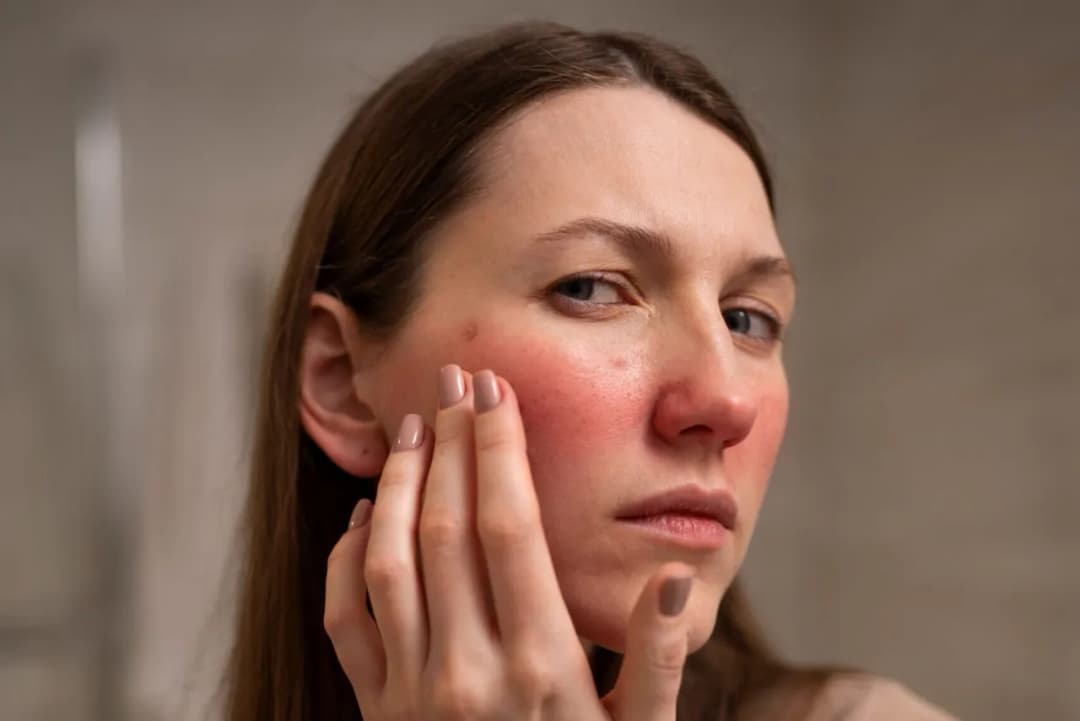 Jakie kwasy do cery naczynkowej? Odkryj najlepsze rozwiązania dla skóry